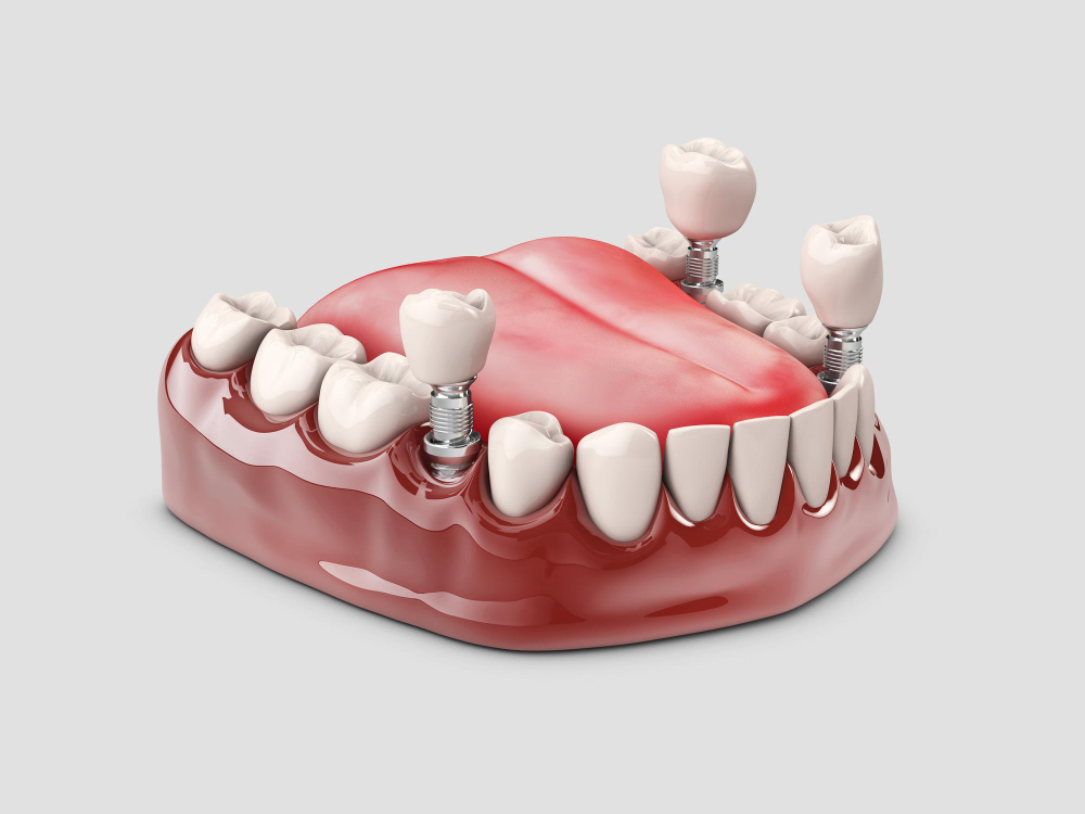 human-teeth-dental-implant-3d-illustration (1).jpg